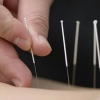 Steril tbb hacamat (kupa terapisi) , akupunktur